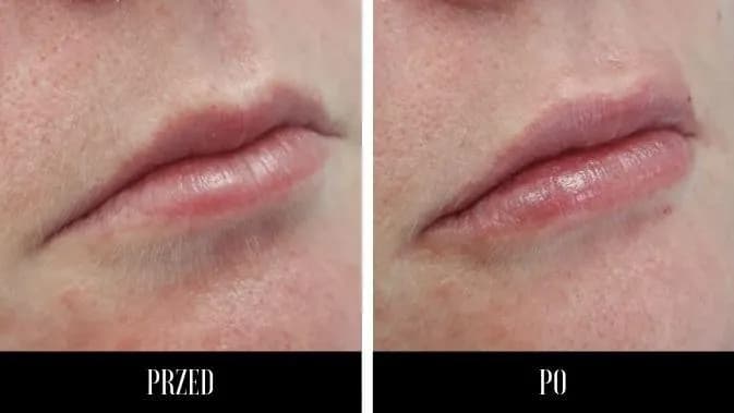 Usta kwasem hialuronowym: 6-12 miesięcy? Sprawdź, co wpływa!