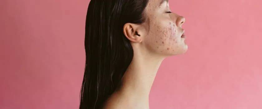 Koniec z ranami po pryszczach! Skuteczna pielęgnacja i usuwanie śladów