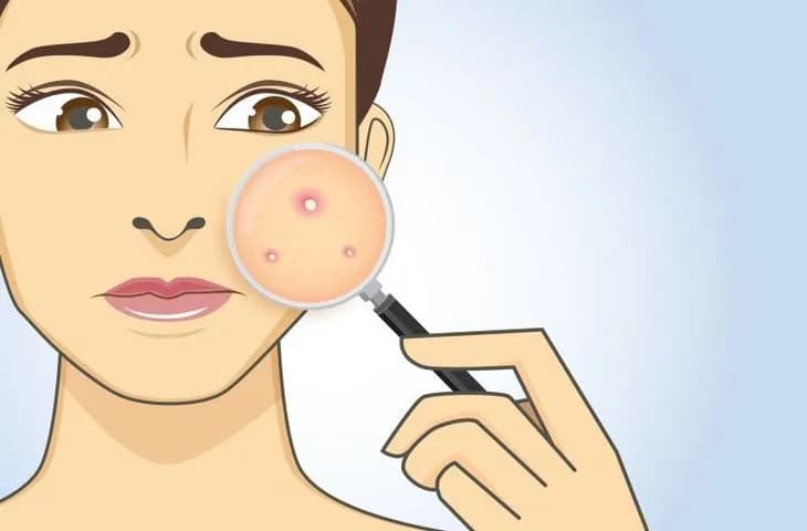 Co na pryszcz podskórny? Szybkie i bezpieczne dojrzewanie "guli"