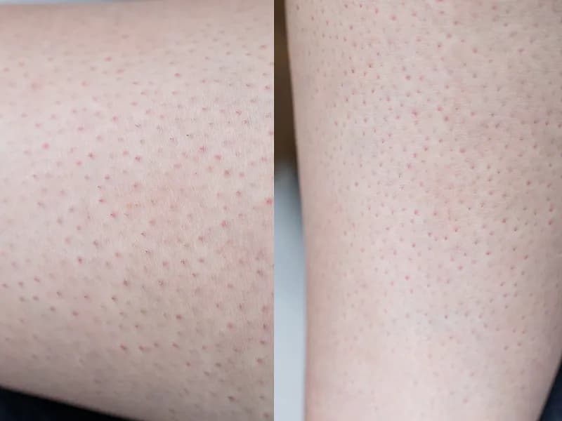 Skóra po depilacji laserowej: Jak wygląda i jak o nią dbać?