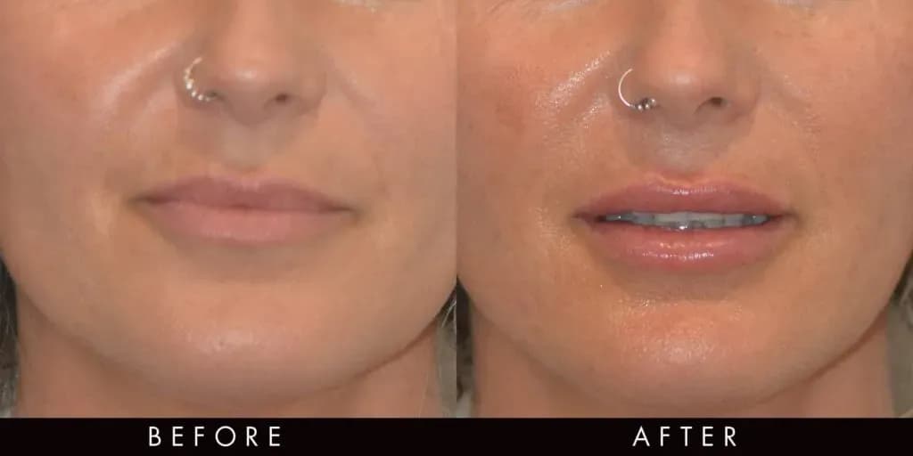 0,5 ml kwasu hialuronowego: Ile kosztuje i jakich efektów się spodziewać?