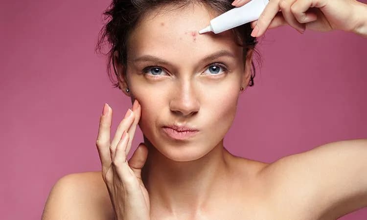 Jak usunąć pryszcze z twarzy? Skuteczne metody i porady eksperta
