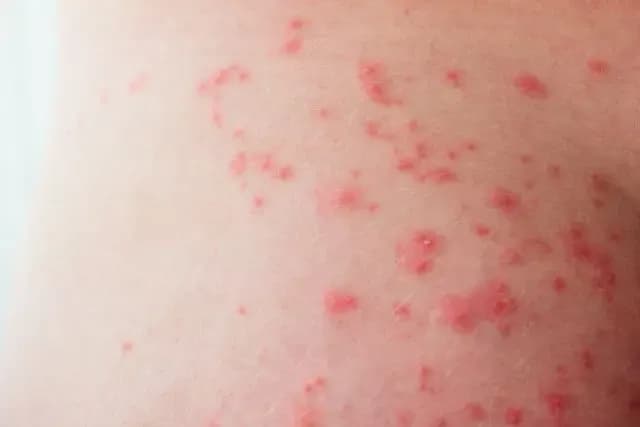 Krostki na pośladkach: Przyczyny i skuteczne sposoby na gładką skórę