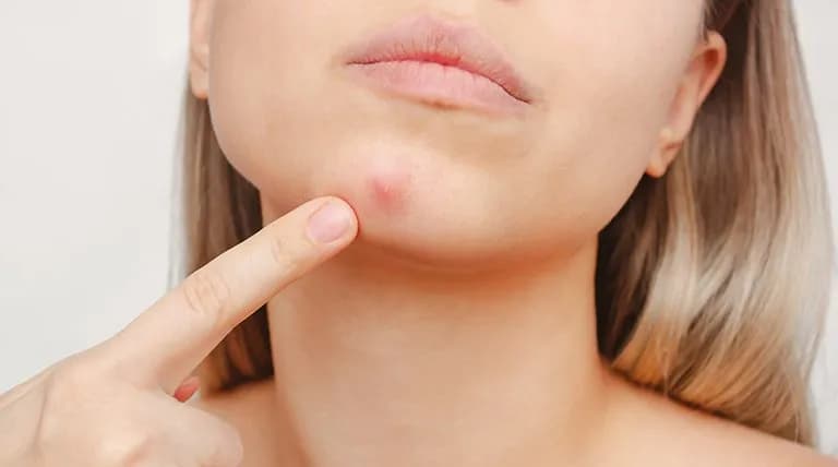 Jak szybko pozbyć się pryszcza? Bez wyciskania i blizn!