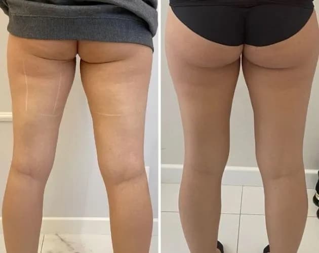 Redukcja cellulitu na udach: Twój plan na gładką skórę