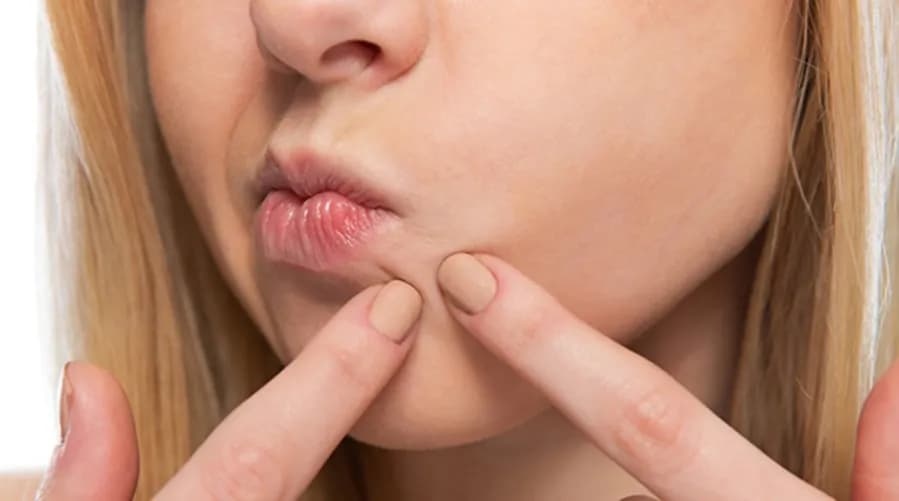 Ropny pryszcz: Jak go usunąć bezpiecznie? Domowe i apteczne sposoby